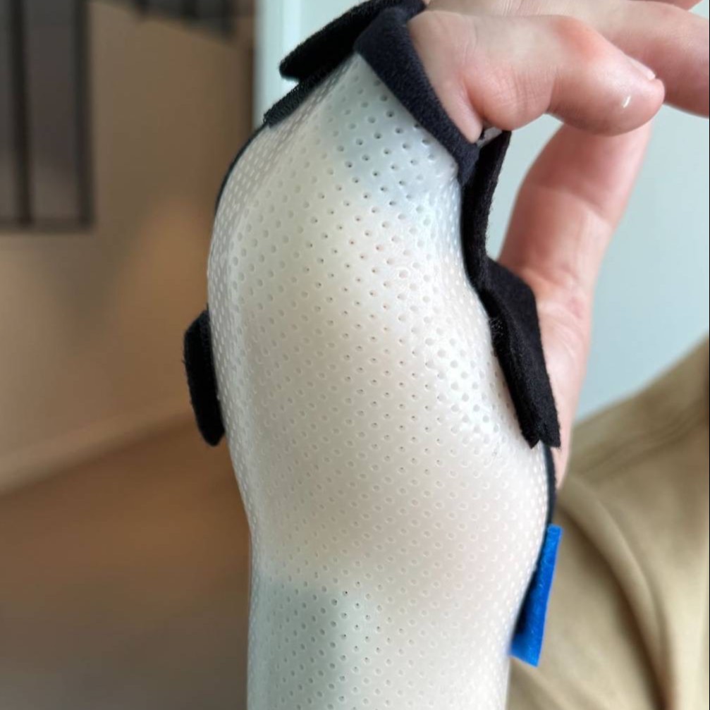 Main portant une attelle orthopédique perforée pour le traitement d'une fracture du boxeur (cinquième métacarpien).